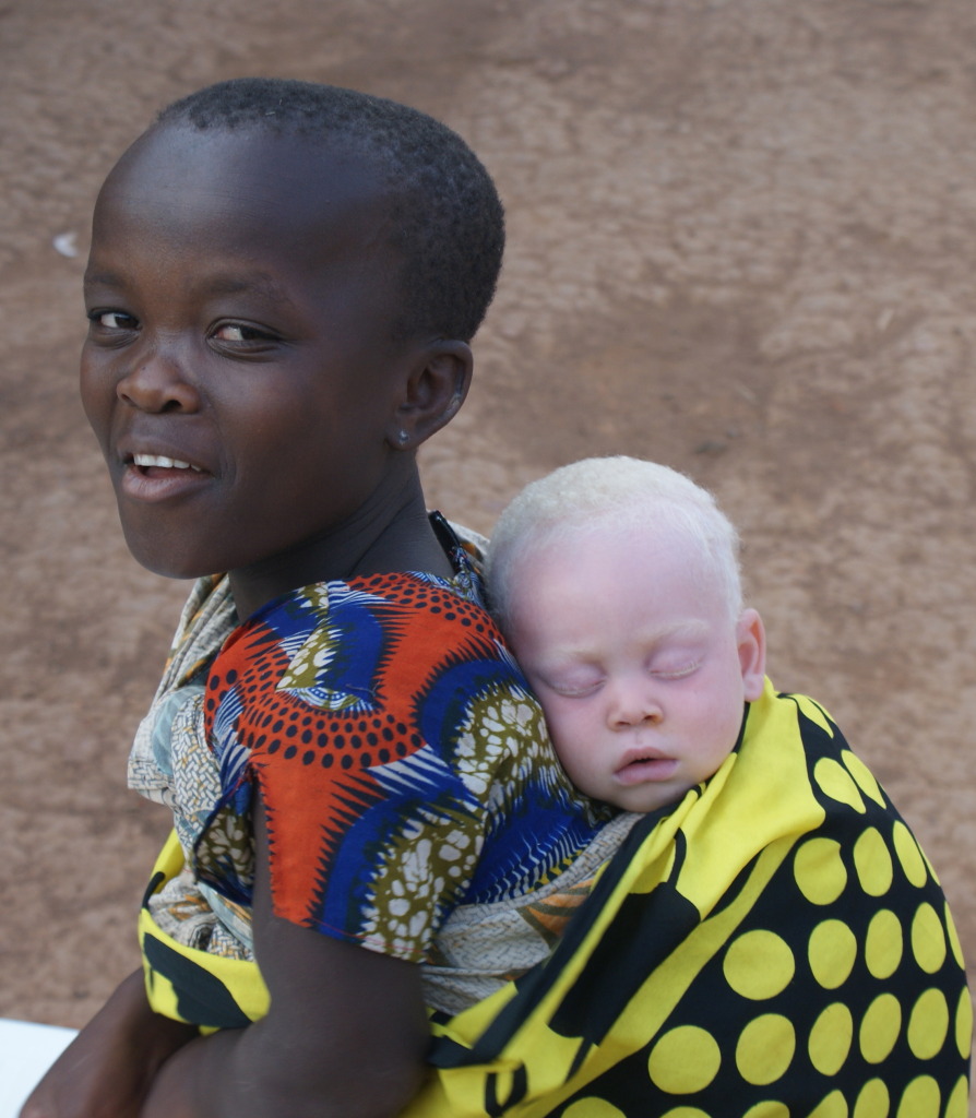 Photo of albino infant with mother at Kabanga.